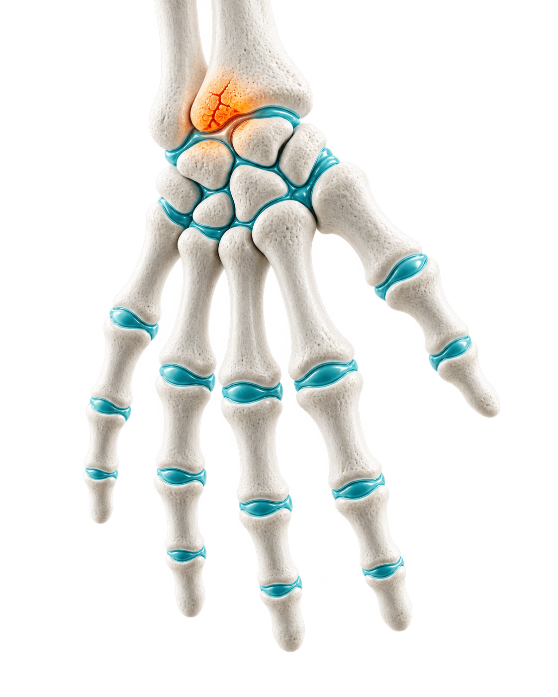 Wrist and hand joint render highlighting capsular inflammation