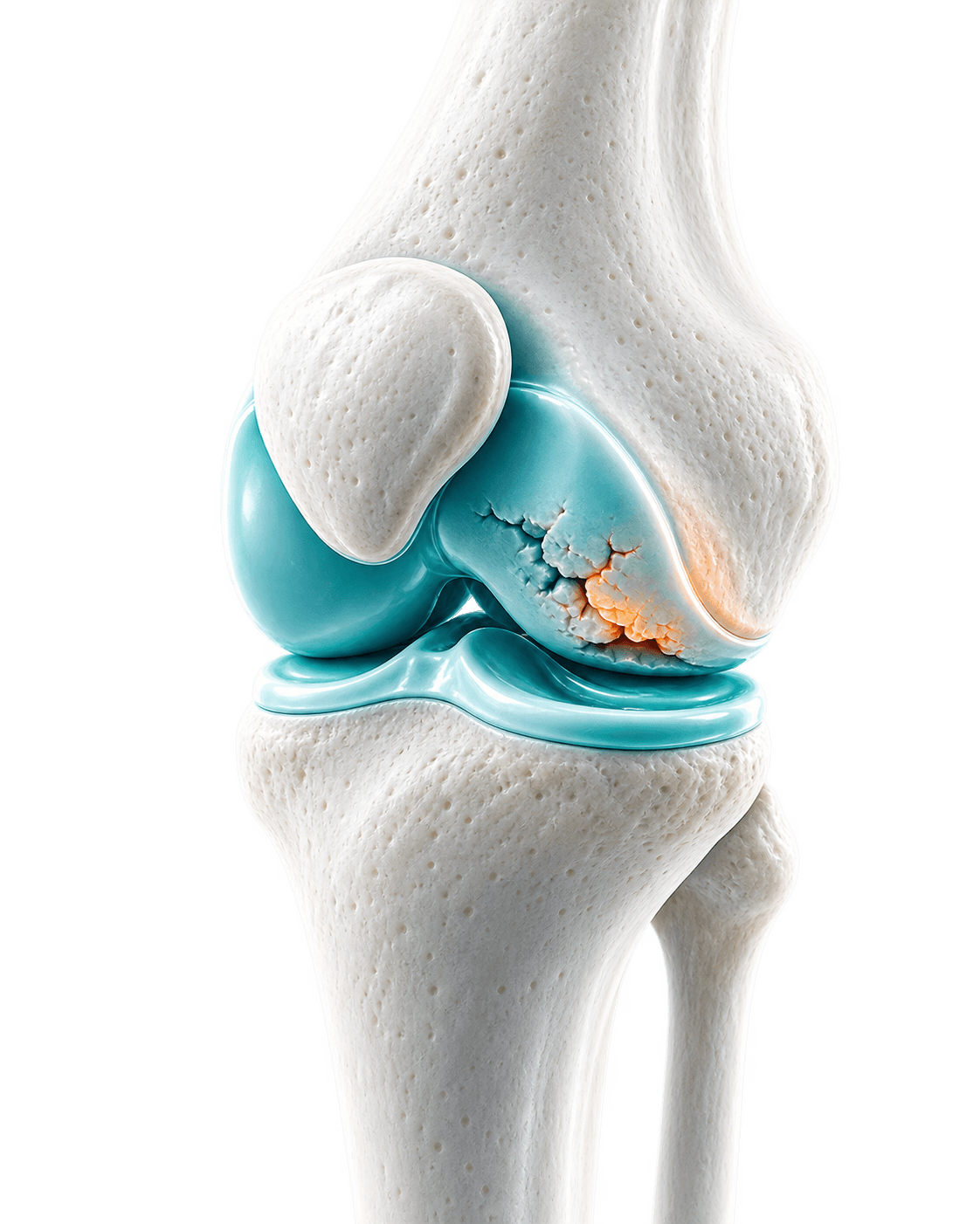 Knee joint render showing cartilage wear on the femoral condyle